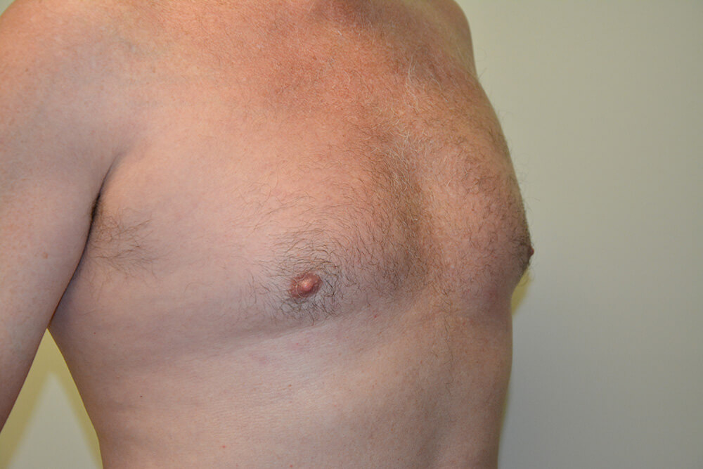 Male-Breast-Reduction-03 | Before Male Breast Reduction 2