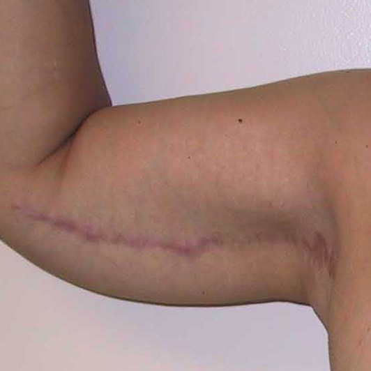 Arm-Lift-03 | After Arm Lift 2