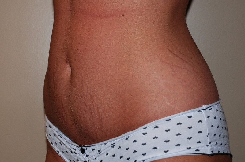 Liposuction-02 | After Liposuction 2