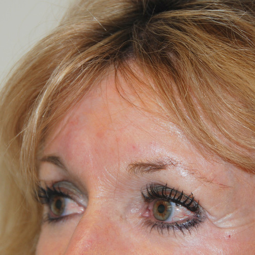 Brow-Lift-03 | Before Brow Lift 2