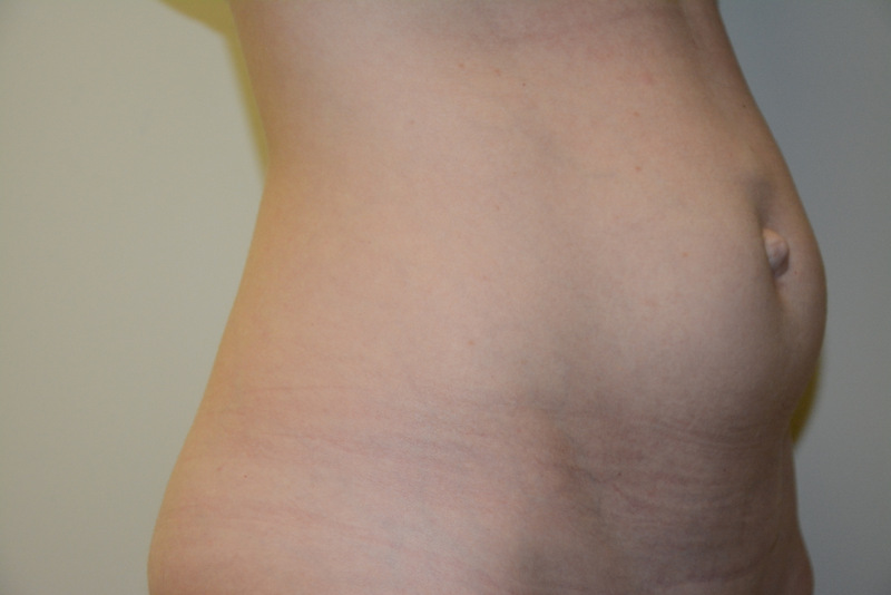 Mini-Tummy-Tuck-03 | Before Mini Tummy Tuck 2