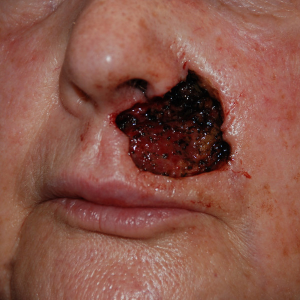 Skin-Cancer-Reconstruction-03 | Before Skin Cancer Reconstruction 2