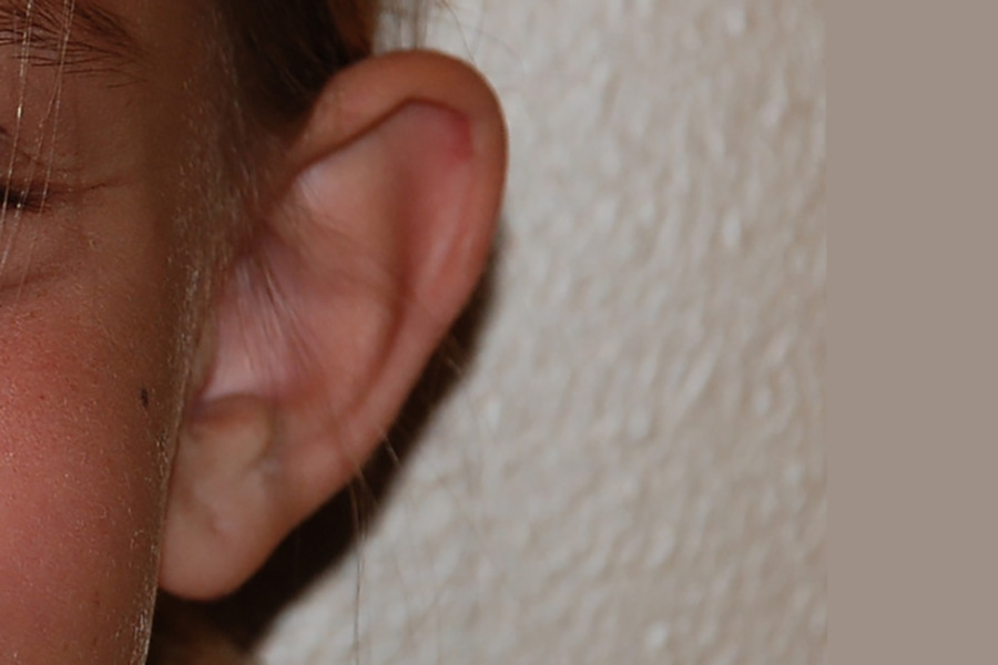 Prominent-Ear-Surgery-03 | Before Prominent Ear Surgery 2