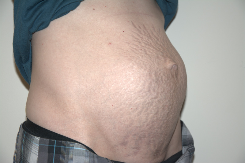 Tummy-Tuck-04 | Before Tummy Tuck 2