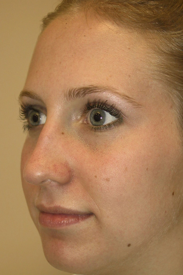 Rhinoplasty-03 | Before Rhinoplasty 2