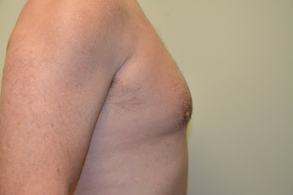 Male-Breast-Reduction-03 | Before Male Breast Reduction 3