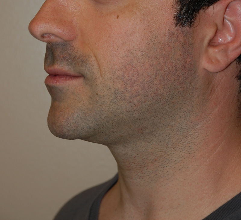 Neck-Liposuction-04 | After Neck Liposuction