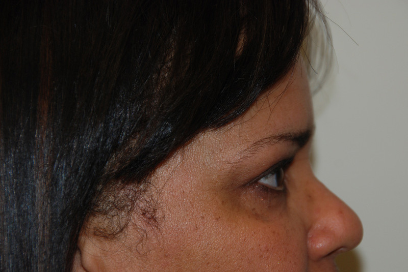 Eyelid-Surgery-05 | Before Eyelid Surgery 4