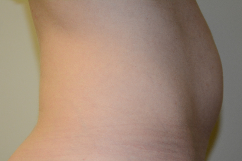 Mini-Tummy-Tuck-03 | Before Mini Tummy Tuck 3