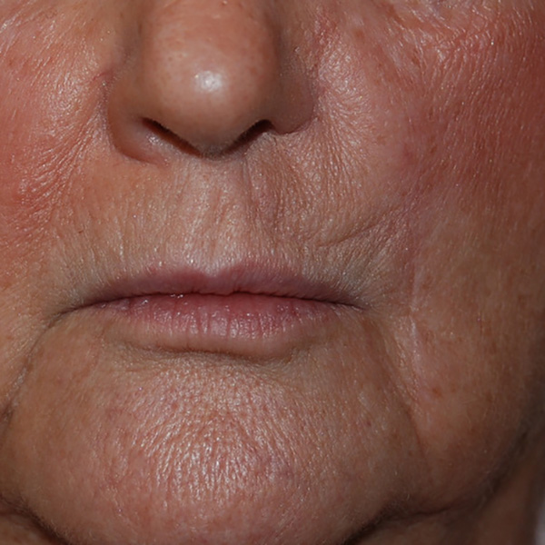 Skin-Cancer-Reconstruction-03 | After Skin Cancer Reconstruction
