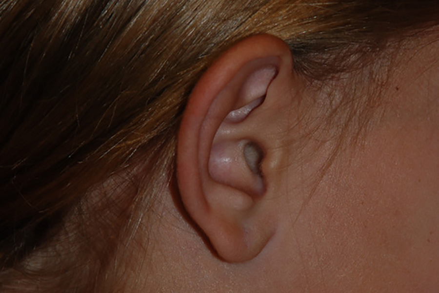 Prominent-Ear-Surgery-03 | Before Prominent Ear Surgery 3