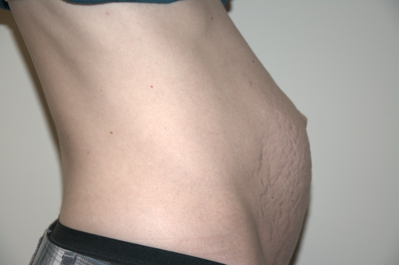 Tummy-Tuck-04 | Before Tummy Tuck 3