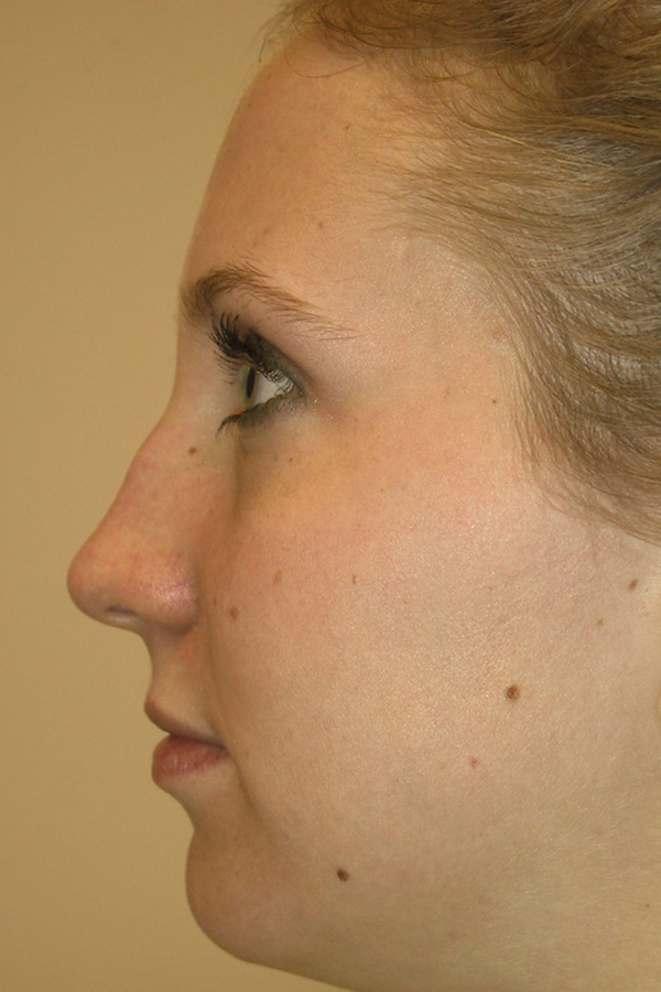Rhinoplasty-03 | Before Rhinoplasty 3