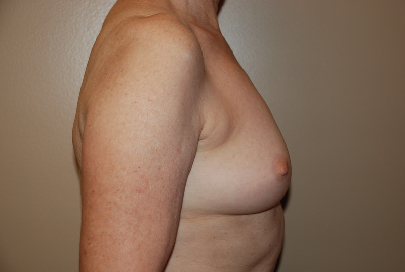 Breast-Reconstruction-Immediate-Implant-03 | Before Breast Reconstruction Immediate Implant 3