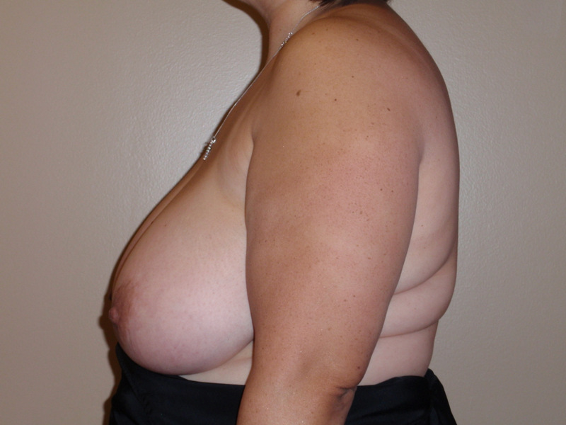 Breast-Reduction-03 | Before Breast Reduction 3