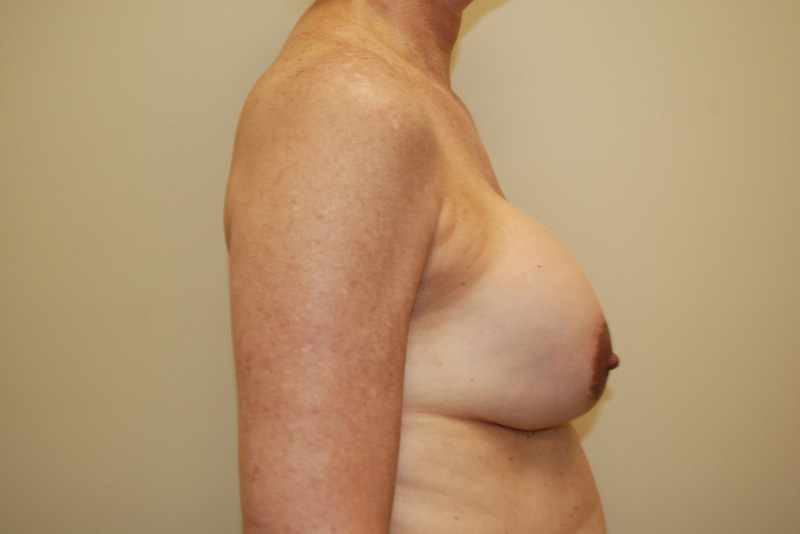 Breast-Revision-03 | Before Breast Revision 3