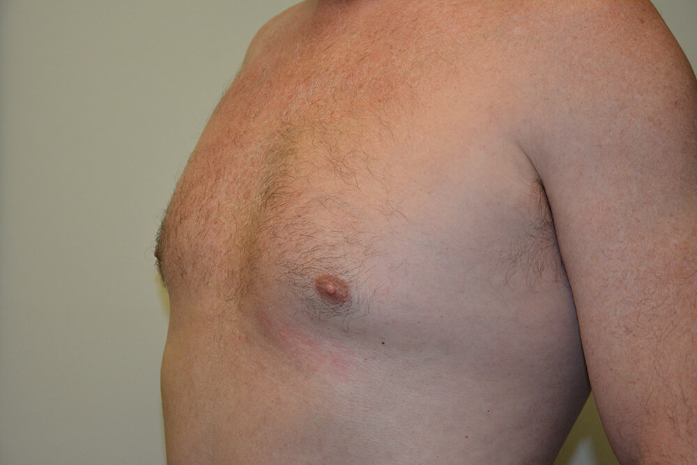 Male-Breast-Reduction-03 | Before Male Breast Reduction 4