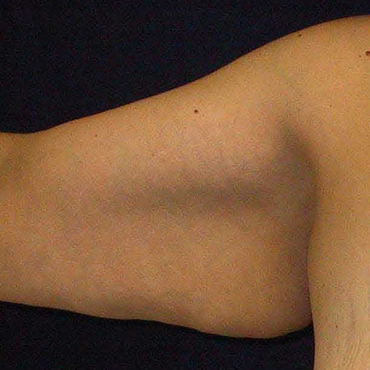 Arm-Lift-03 | Before Arm Lift 2