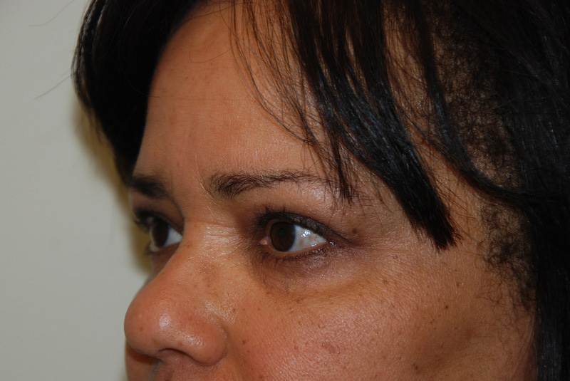 Eyelid-Surgery-05 | Before Eyelid Surgery 3