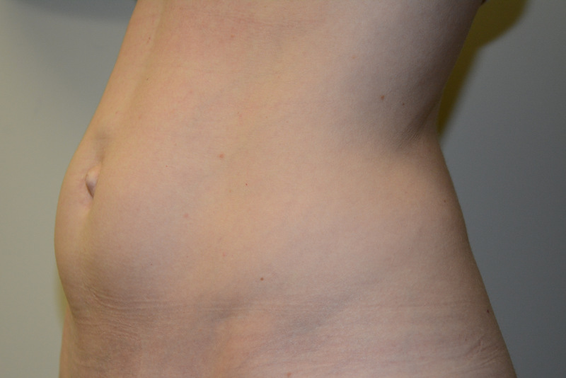 Mini-Tummy-Tuck-03 | Before Mini Tummy Tuck 4