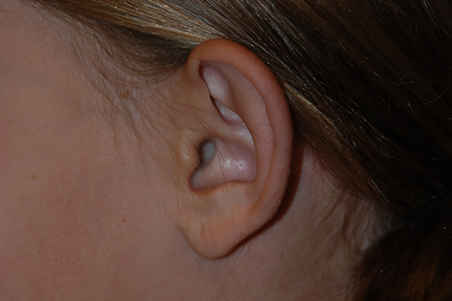 Prominent-Ear-Surgery-03 | Before Prominent Ear Surgery 4