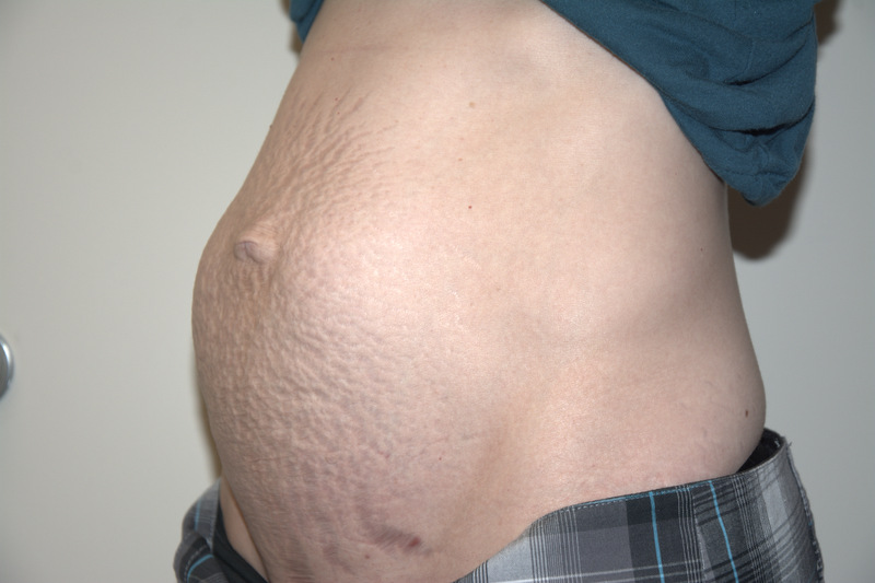 Tummy-Tuck-04 | Before Tummy Tuck 4
