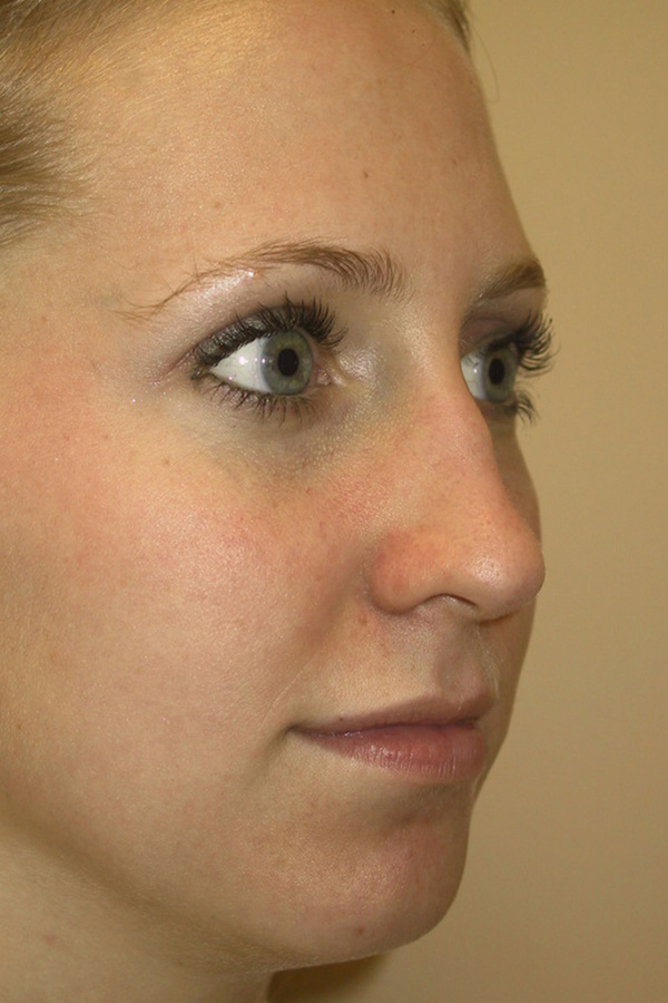 Rhinoplasty-03 | Before Rhinoplasty 4