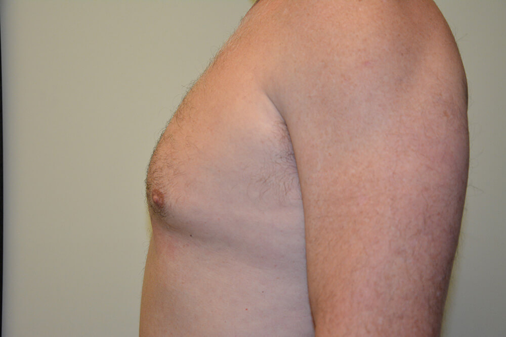 Male-Breast-Reduction-03 | Before Male Breast Reduction 5