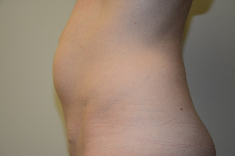 Mini-Tummy-Tuck-03 | Before Mini Tummy Tuck 5