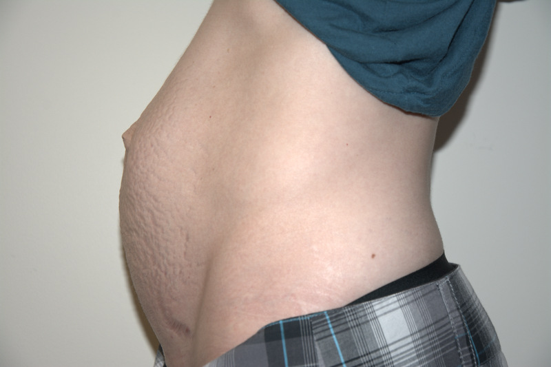 Tummy-Tuck-04 | Before Tummy Tuck 5