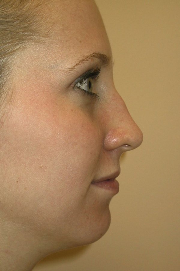 Rhinoplasty-03 | Before Rhinoplasty 5