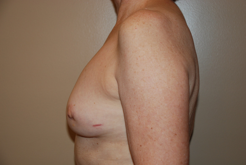 Breast-Reconstruction-Immediate-Implant-03 | Before Breast Reconstruction Immediate Implant 5