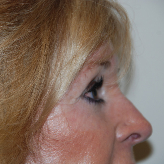 Brow-Lift-03 | Before Brow Lift 5