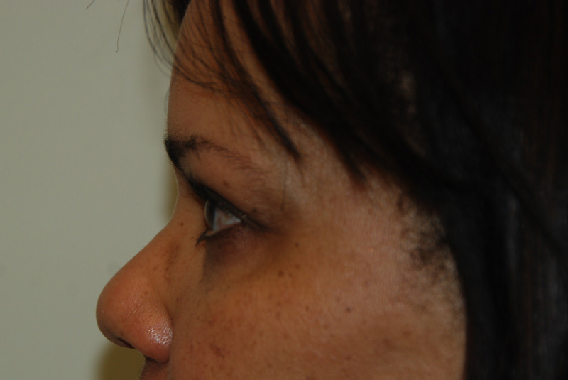 Eyelid-Surgery-05 | Before Eyelid Surgery 5