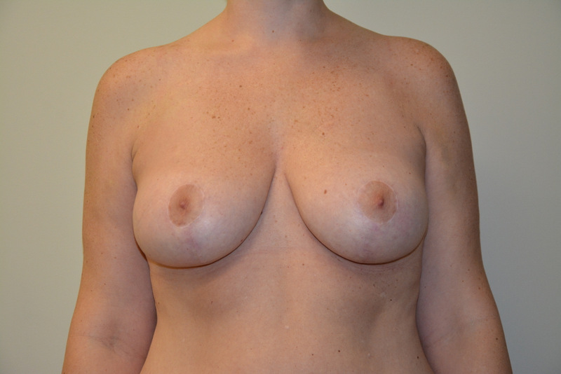 Breast-Lift-03 | After Breast Lift