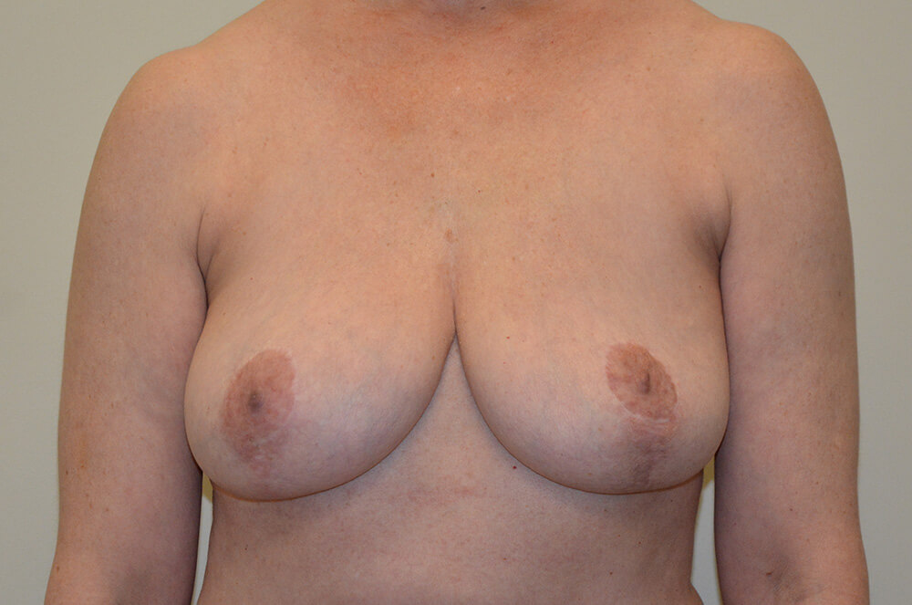 Implant-Removal-02 | After Implant Removal