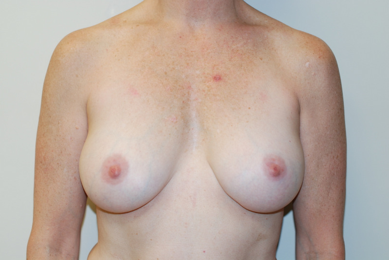 Breast-Augmentation-03 | After Breast Augmentation