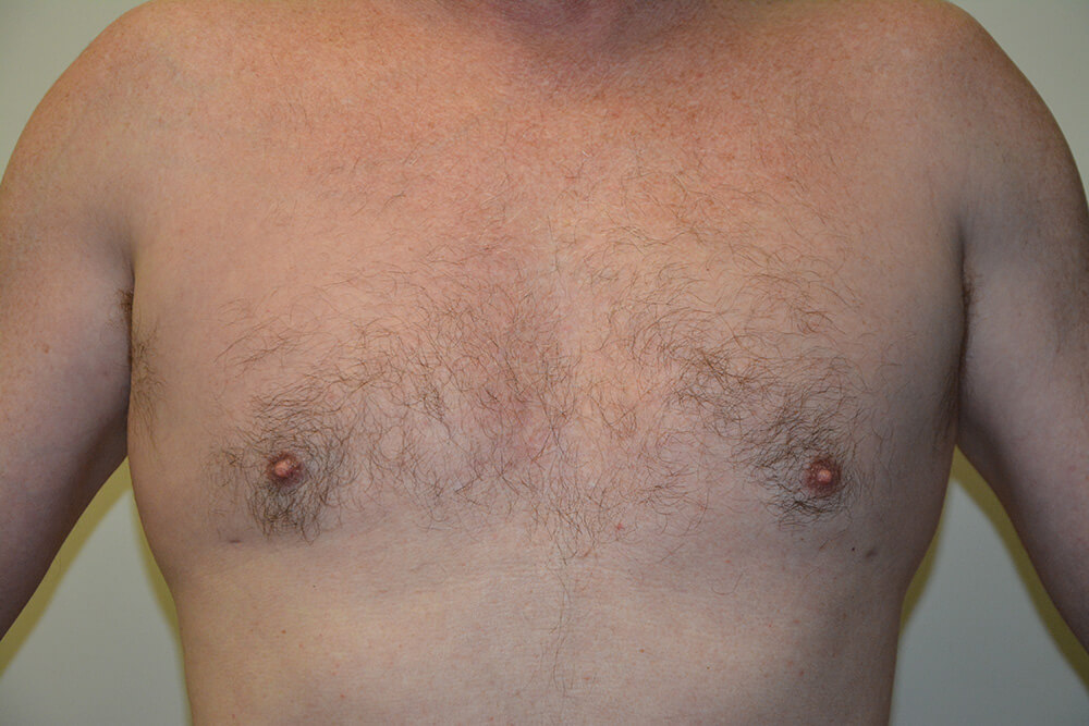 Male-Breast-Reduction-03 | After Male Breast Reduction