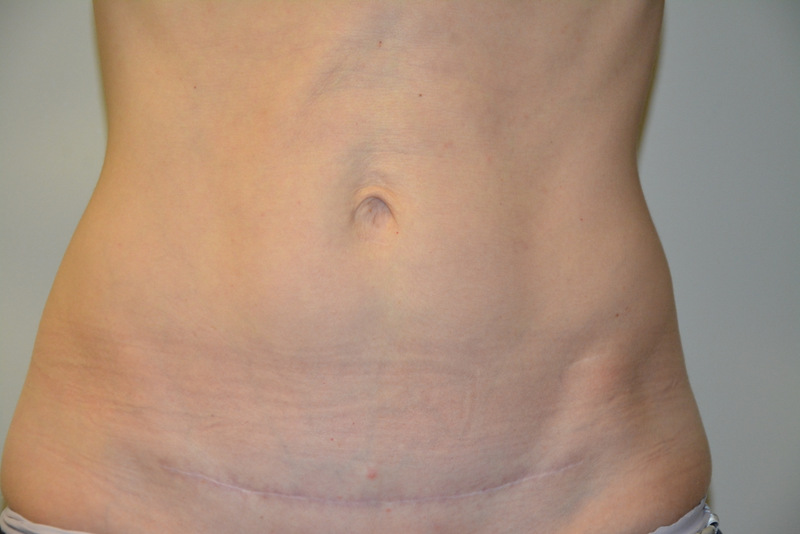 Mini-Tummy-Tuck-03 | After Mini Tummy Tuck 1