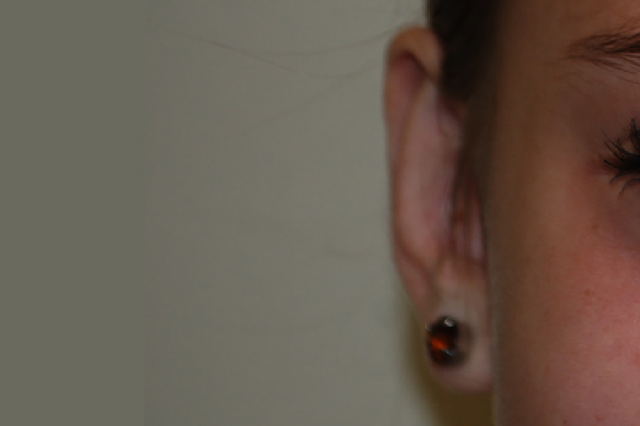 Prominent-Ear-Surgery-03 | After Prominent Ear Surgery