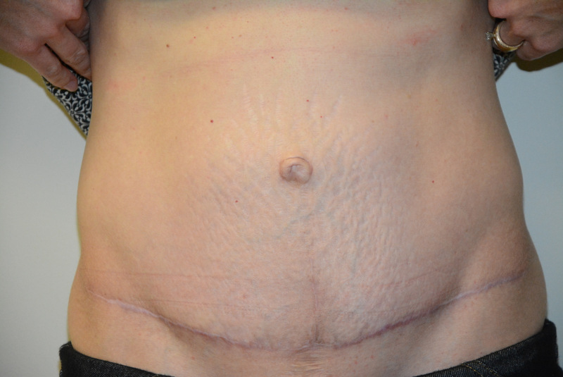 Tummy-Tuck-04 | After Tummy Tuck