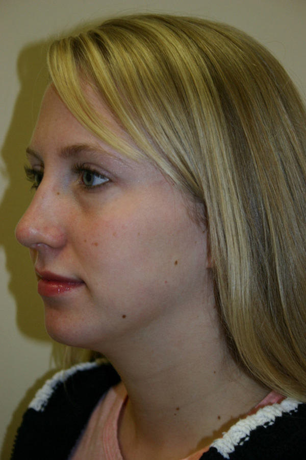 Rhinoplasty-03 | After Rhinoplasty 2