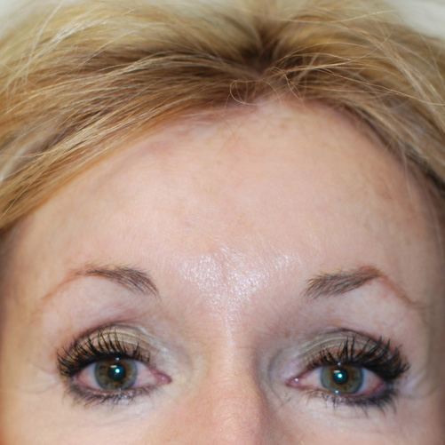 Brow-Lift-03 | After Brow Lift