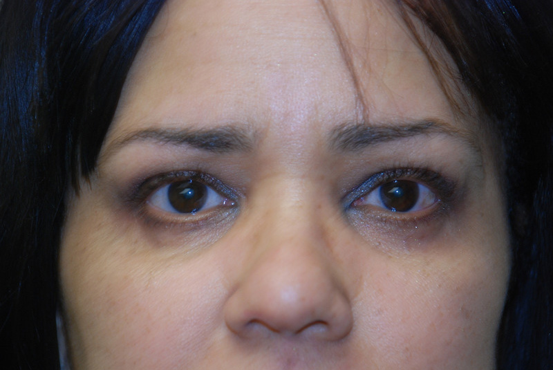 Eyelid-Surgery-05 | After Eyelid Surgery 1