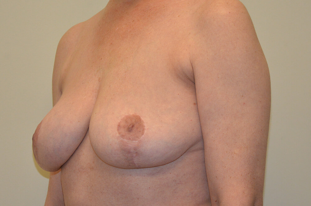 Implant-Removal-02 | After Implant Removal 4