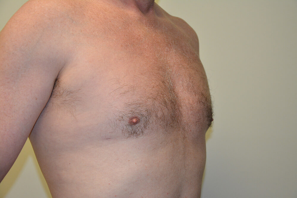 Male-Breast-Reduction-03 | After Male Breast Reduction 2