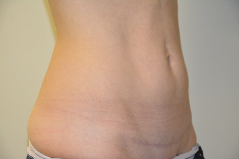 Mini-Tummy-Tuck-03 | After Mini Tummy Tuck 2