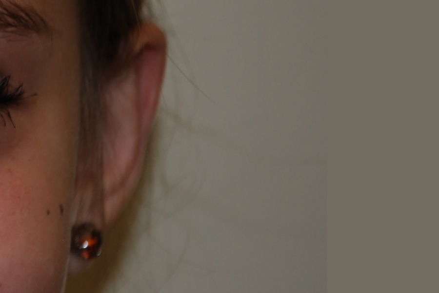 Prominent-Ear-Surgery-03 | After Prominent Ear Surgery 2