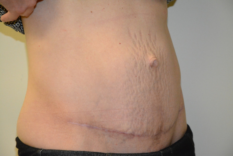 Tummy-Tuck-04 | After Tummy Tuck 2
