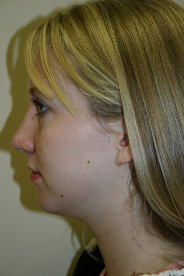 Rhinoplasty-03 | After Rhinoplasty 3